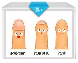包皮包茎示意图