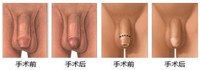 包皮手术后效果图