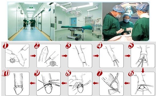 包皮内外板分层美容微雕术